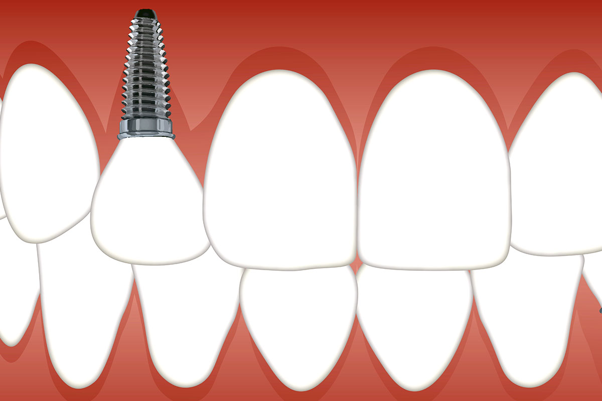 Dental Implants