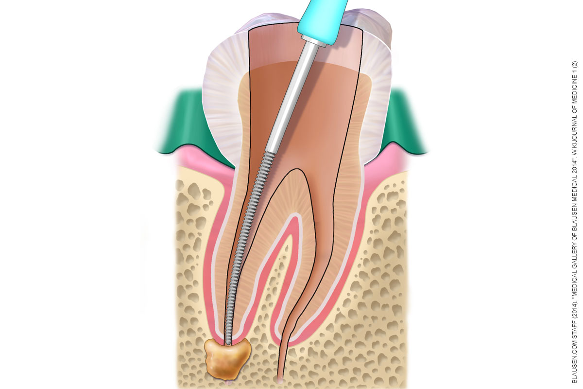 Root Canals